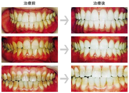 ホワイトニング施術例 治療前治療後の比較